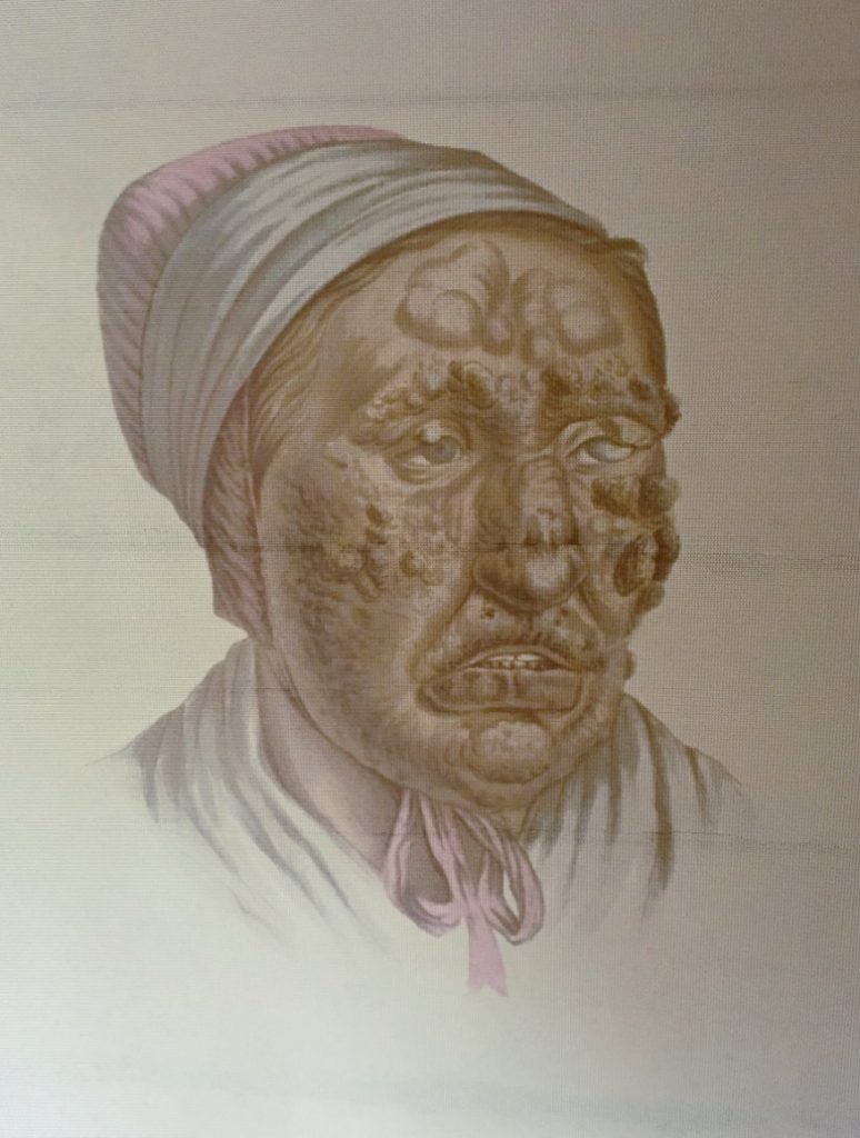 A picture of a leprosy patient in Bergen, Norway